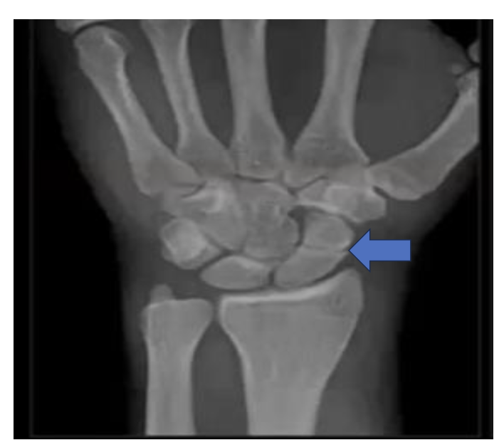 <p>type of fracture ?</p>