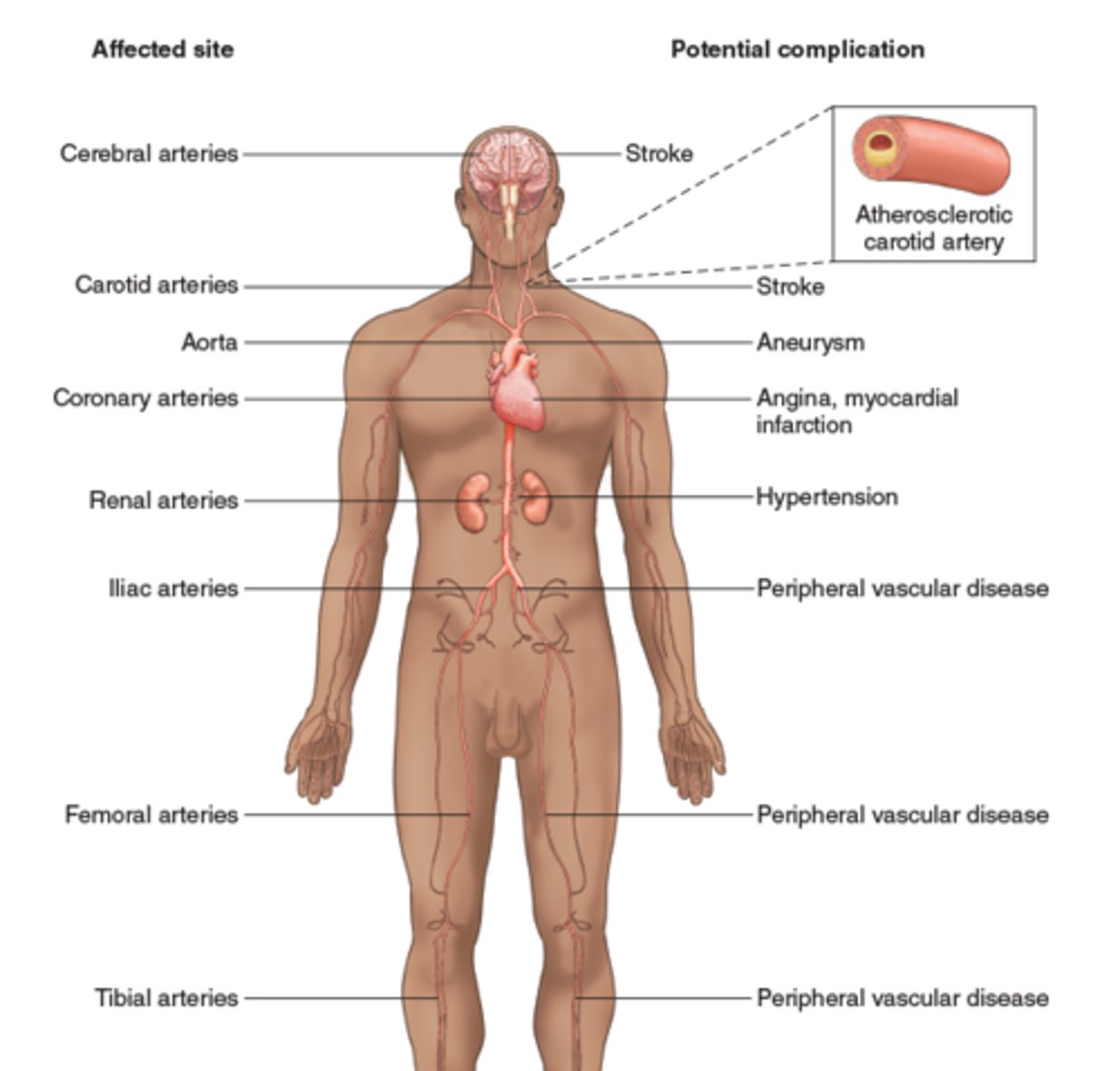 <p>Hardening of arteries due to plaque buildup. </p>