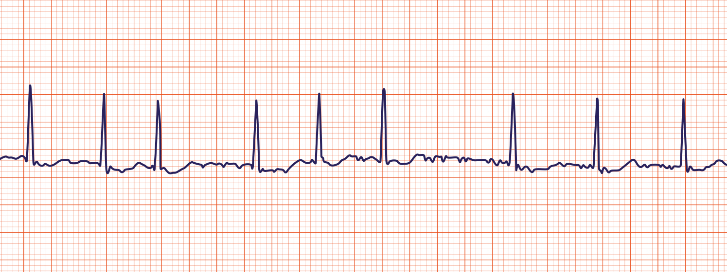 <p>Atrial Fibrillation</p><p></p><p>Treated by cardioversion, propranolol, digitalis</p>