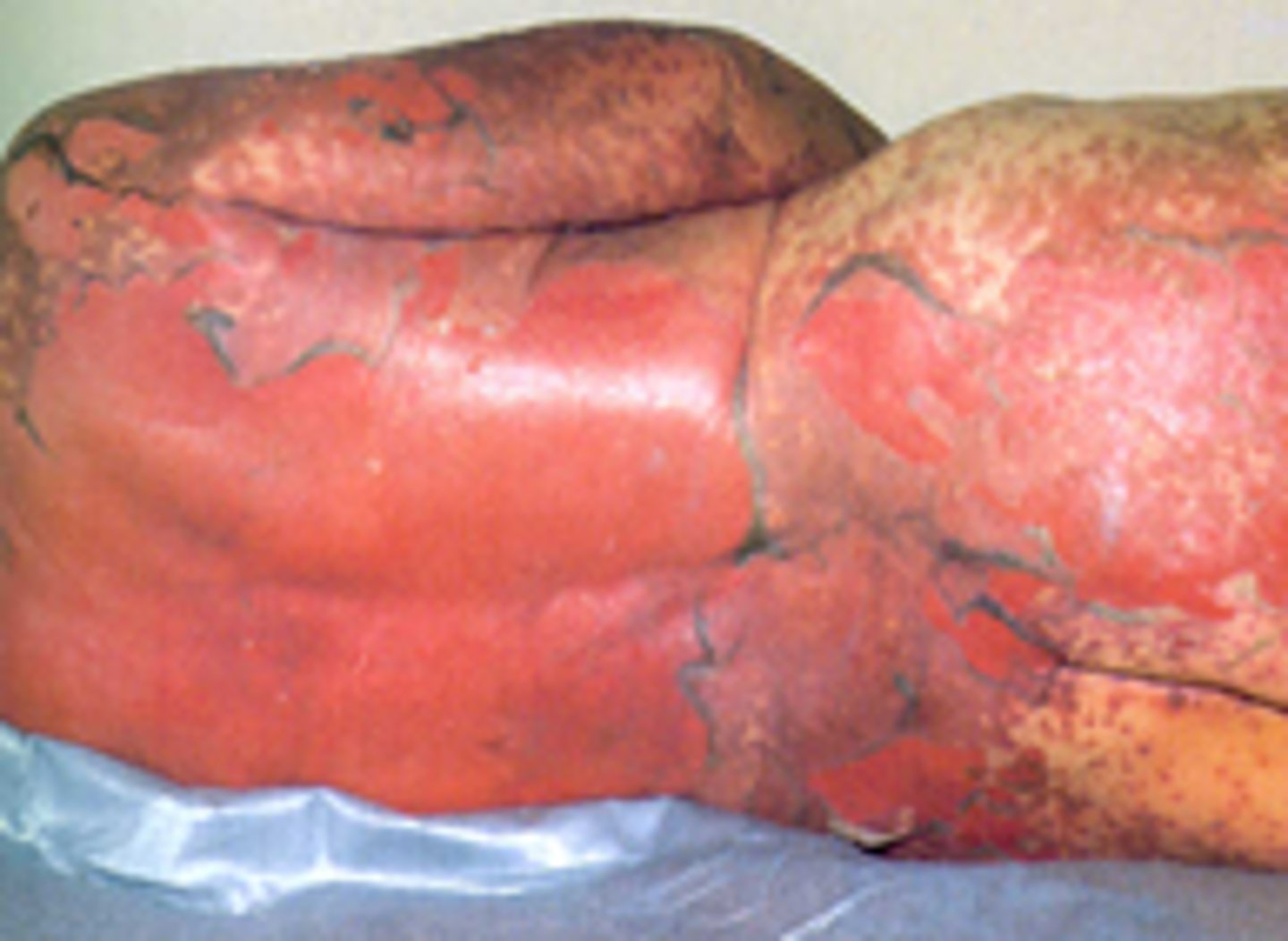 <p>diagnose this:</p><p>Starts w/ fever, photophobia, mucosal inflammation, sore throat/mouth, painful papules</p>