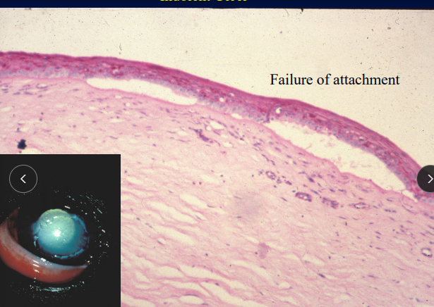 <p><span style="background-color: transparent;"><strong><span>Indolent Ulcer</span></strong></span></p>