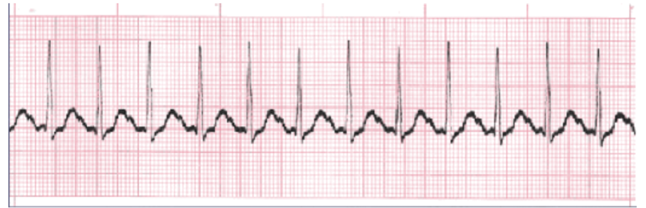 <p>What is the rhythm?</p>