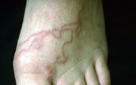 <p>What parasite is responsible for this in humans and what is the condition called?</p>