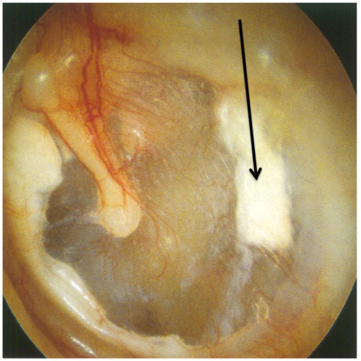 <p>White spots and streaks</p>