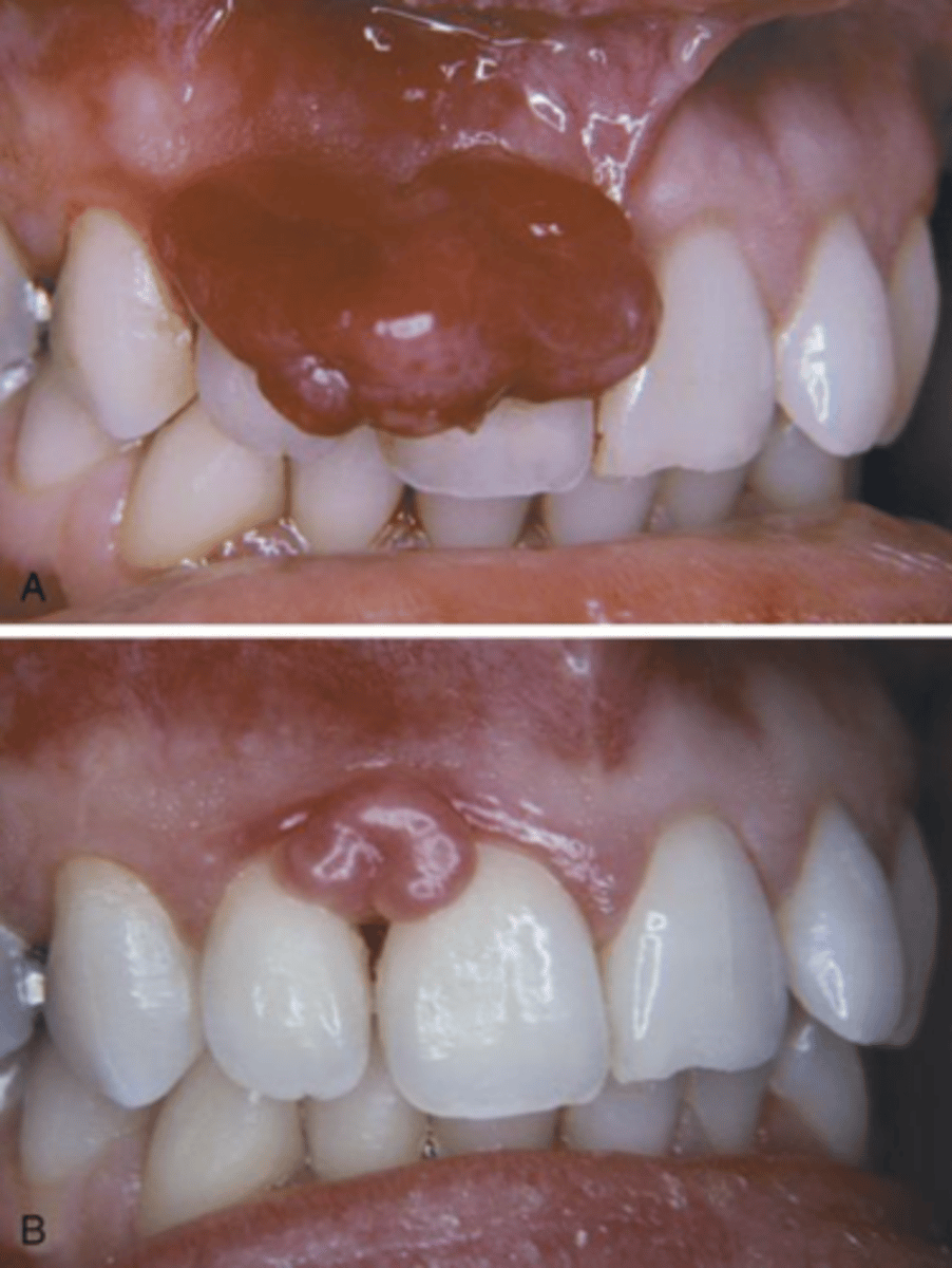 <p>• 75% on the gingiva</p><p>• Sometimes called the</p><p>“pregnancy tumor”</p><p>• Smooth or lobulated vascular</p><p>mass</p><p>• Pink-red-purple</p><p>• Usually ulcerated</p>