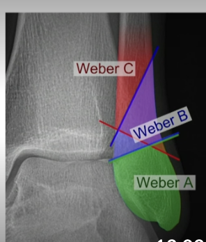 <p>Weber A = stable, lower; WBAT </p><p>Weber B=higher up @ ankle joint, potentially unstable, immobilize, NWB, Urgent ortho follow up. </p><p>Weber C = higher up at ankle joint, needs surgery </p>