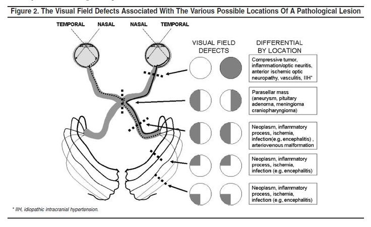 <ul><li><p>Monocular Vision Loss - the inability to see with one eye</p></li><li><p>Bitemporal Hemianopia - a condition where vision is impaired in the outer (temporal) halves of both visual fields.</p></li><li><p>Contralateral Homonymous Hemianopia - a visual field loss where the same half of the visual field is affected in both eyes</p></li><li><p>Contralateral Superior Quadrantopia - a visual field defect where a person loses vision in the upper quadrant of their field of view (on the same side)</p></li><li><p>Contralateral Inferior Quadrantopia - a visual field defect where a person loses vision in the lower quadrant of their field of view (on the same side)</p></li></ul><p>Neoplasm and inflammatory process cause _______, _______ and _______.</p>