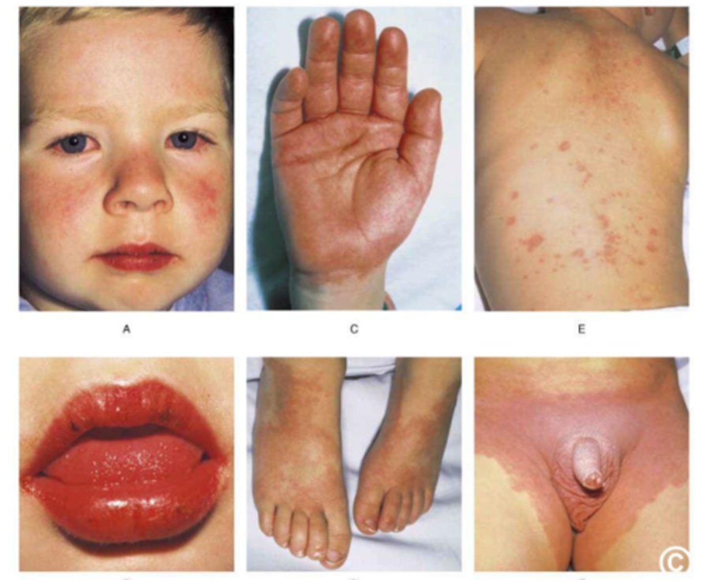 <p>-fever &gt;5 days and at least four of the sx</p><p>-conuunctivits</p><p>-lip cracking and fissuring, strawberry tonue, inflammation of oral mucosa</p><p>-polymorphous exanthem</p><p>-redness and swelling of hands and feet</p><p>-cardio manifestation</p>