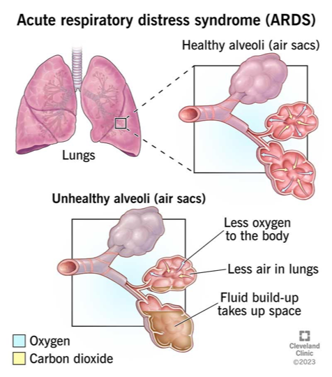 <p>Acute Respiratory Distress Syndrome (ARDS)</p>