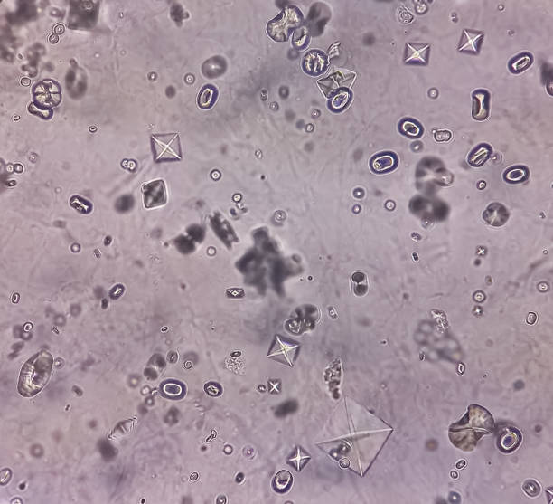 <p>Seen in joint problem<br>2 forms:<br>Wheddelite <br>Whewellite </p>