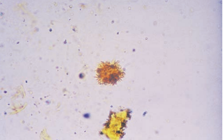 Bilirubin crystals