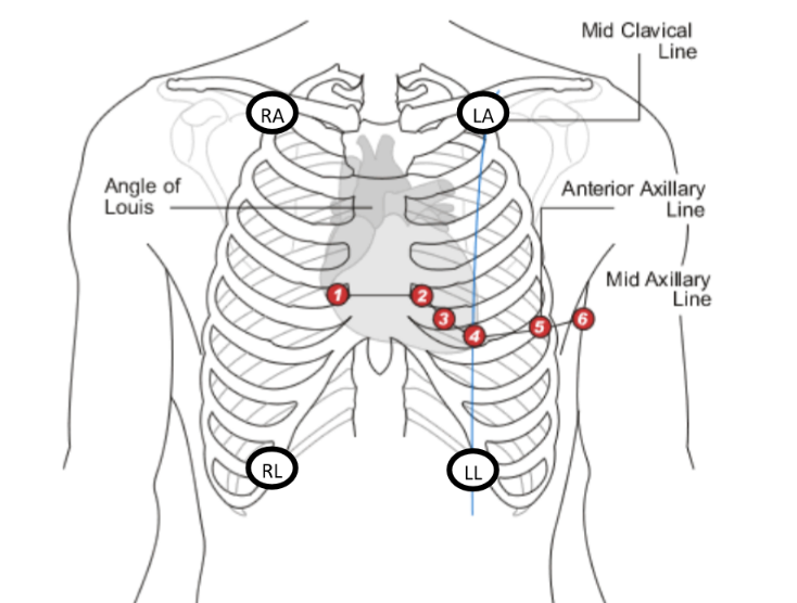 V1- palpate down to sternal angle and go to right sternal border (IC2) and down two spaces (IC space 4) 

V2 - left sternal border (IC space 4) 

V3- half way between V2 and V3

V4- IC space 5 in left mid clavicle line 

V5- anterior axillary line 

V6- mid axillary line