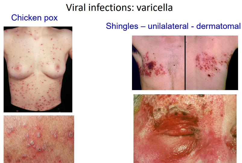 <p>chicken pox (polymorphic)and shingles</p>