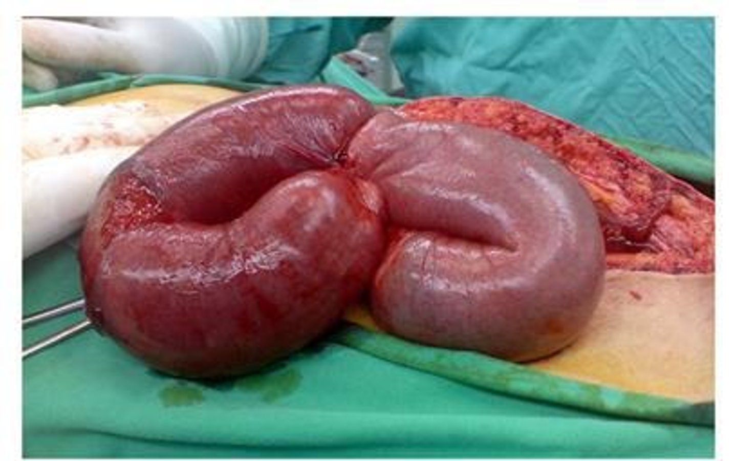 <p>Abdominal X-ray, CT scan, labs including CBC and electrolytes, and high-pitched hyperactive bowel sounds.</p>