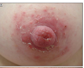 <p><strong>Areolar Dermatitis</strong></p><p>-Typically presents as _____ and painful __________ of the areola and nipples with a red scaly ____</p><p>-More common in women with a history of eczema or __________</p><p>-Management → avoid potential irritants and allergens, medium potency topical ________ applied after feeding </p>