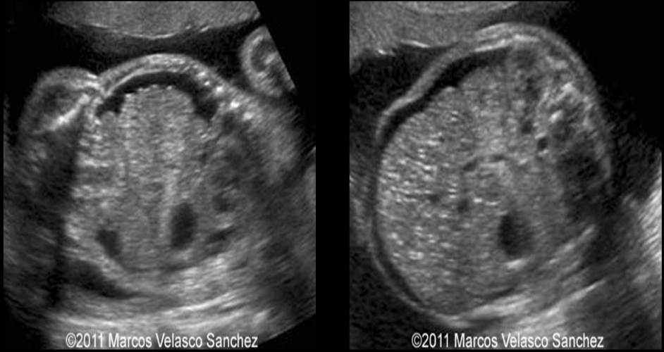 <p>a) echogenic bowel</p><p>b) toxoplasmosis infection</p><p>c) mesenchymal hamartoma</p><p>d) omphalocele </p>