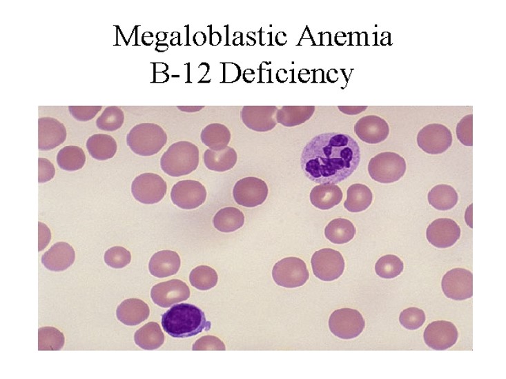 B-12 deficiency or folate deficiency or intrinsic factor deficiency

increased lobes and large cell