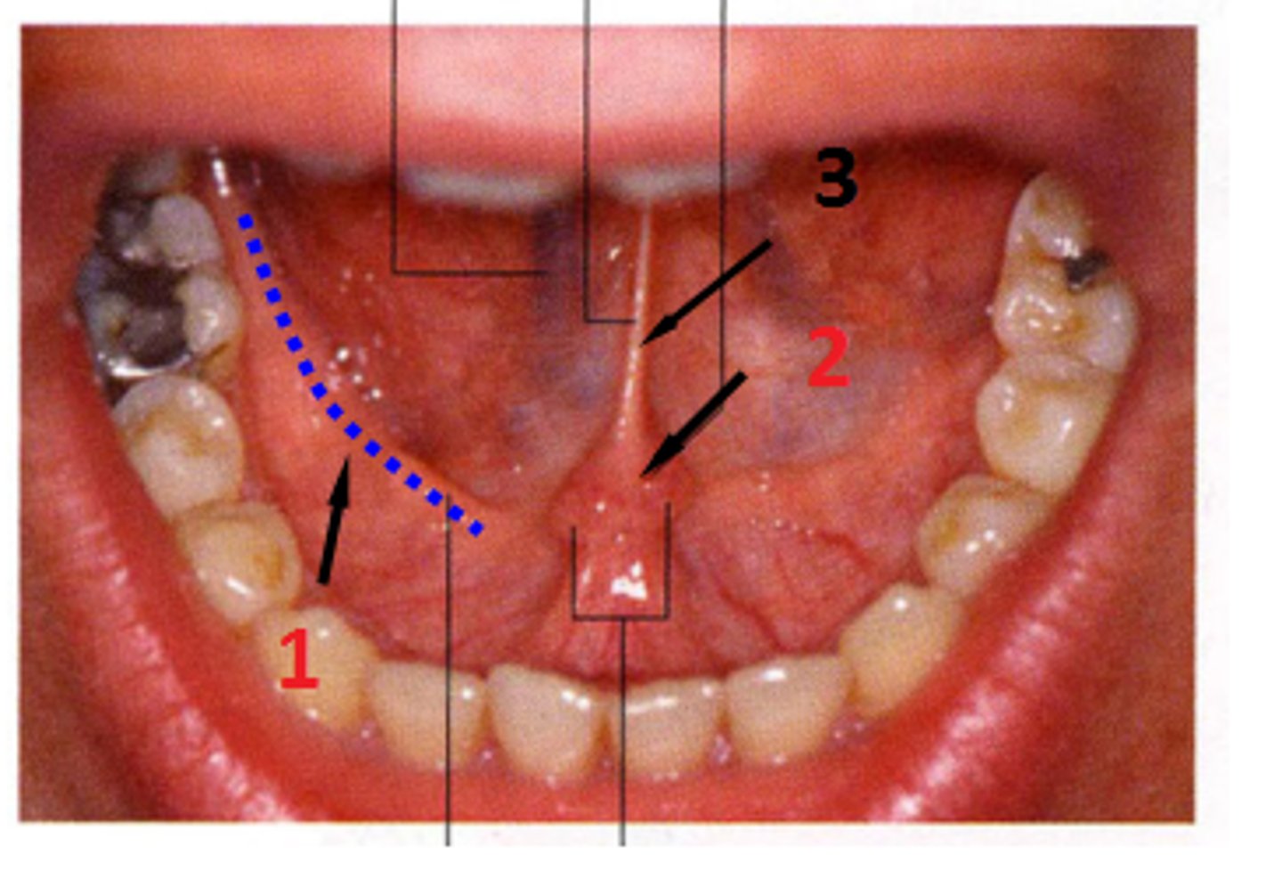 <p>a 'v' shaped ridge of tissue on each side of the frenum, which empty the sublingual glands</p>