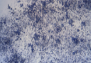 <p>Name this ALKALINE crystal that resembles sand in an old urine, what is it associated with? normal or abnormal?</p>