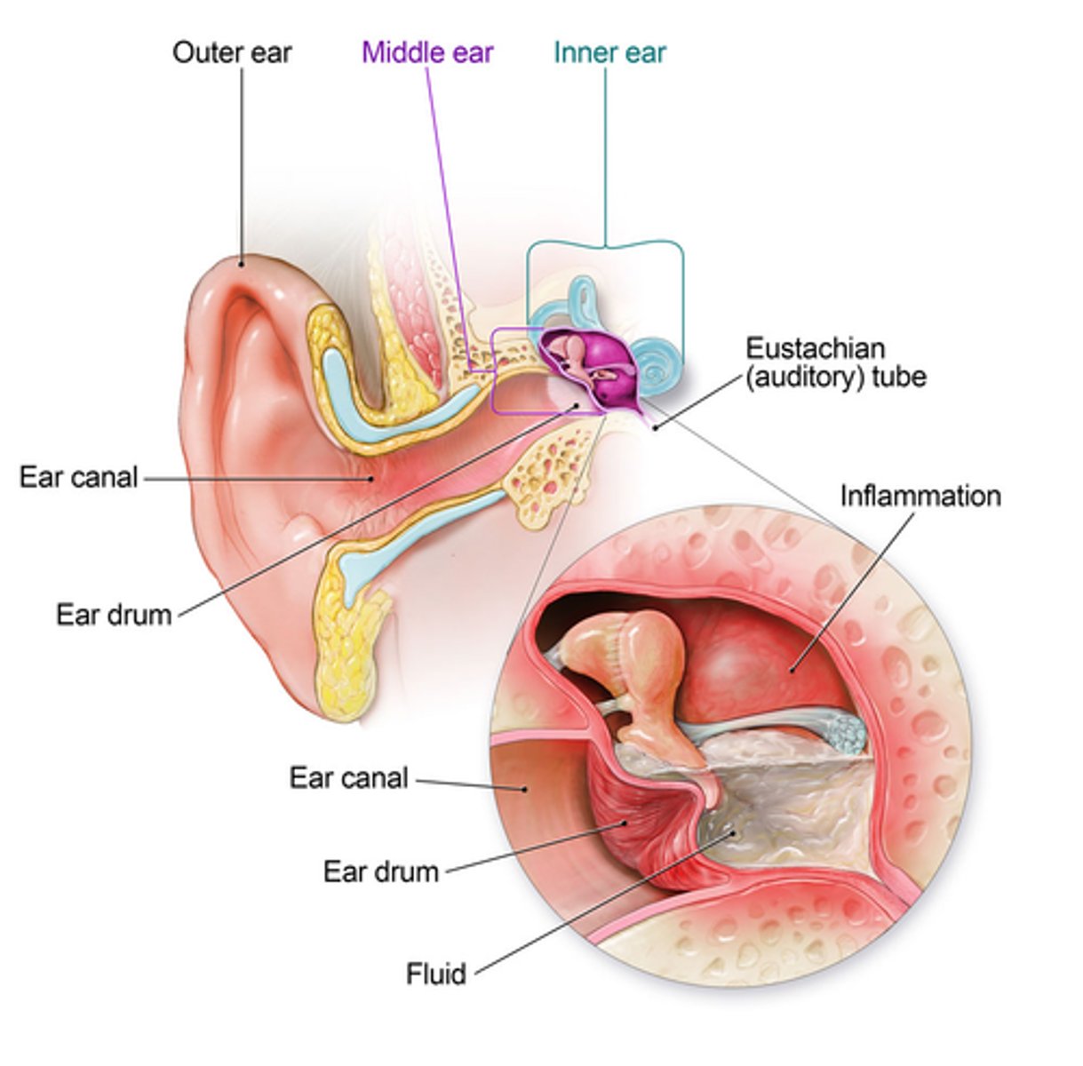 <p>1) Eustachian tube inflammation → obstructed drainage of fluids</p><p>2) Viruses / bacteria grow in excess fluids</p><p>3) Trapped air in middle ear is gradually resorbed, causing inward traction 1st on tympanic membrane</p><p>4) Eventually, inflammation due to infection causes increased fluid in middle ear, causing the tympanic membrane to bulge outward 2nd</p><p>5) Pressure of pus and fluids causes pain and decreased hearing </p><p>*Spontaneous perforation of tympanic membrane may have occurred: indicated by drainage of pus and fluids into external ear canal*</p><p>*Fever often accompanies bacterial otitis media*</p>