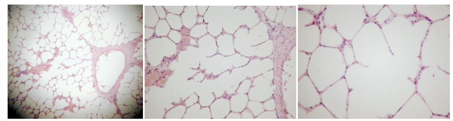 <p>emphysema alveolare chronic</p><ul><li><p>septa is broken and air area increased</p></li></ul><p></p>