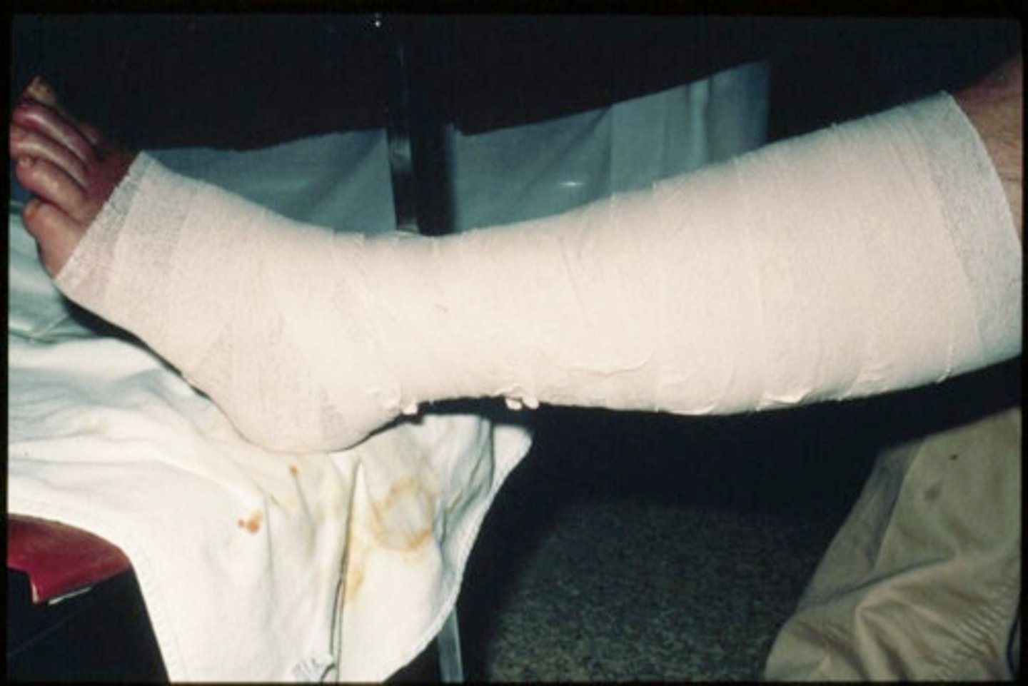 <p>Unna boot is pliable, non-stretchable dressing impregnated with ointments used for venous insufficiency ulcers to control edema and help with healing</p>