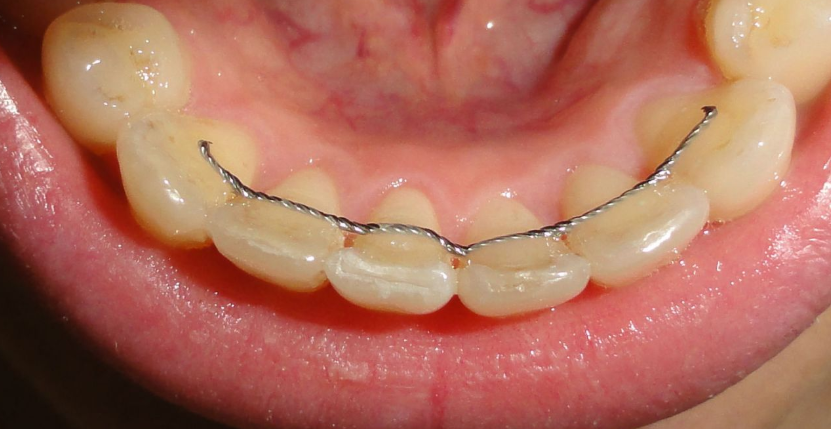 <ul><li><p>frictional contact of long parallel walls of attachment, they are mechanical locking devices and that provide resistance to deformation of resilient locking materials</p></li><li><p>retentive clasp arms on lingual surface of abutment can frequently provide or supplement retention for attachments</p></li></ul><p></p>