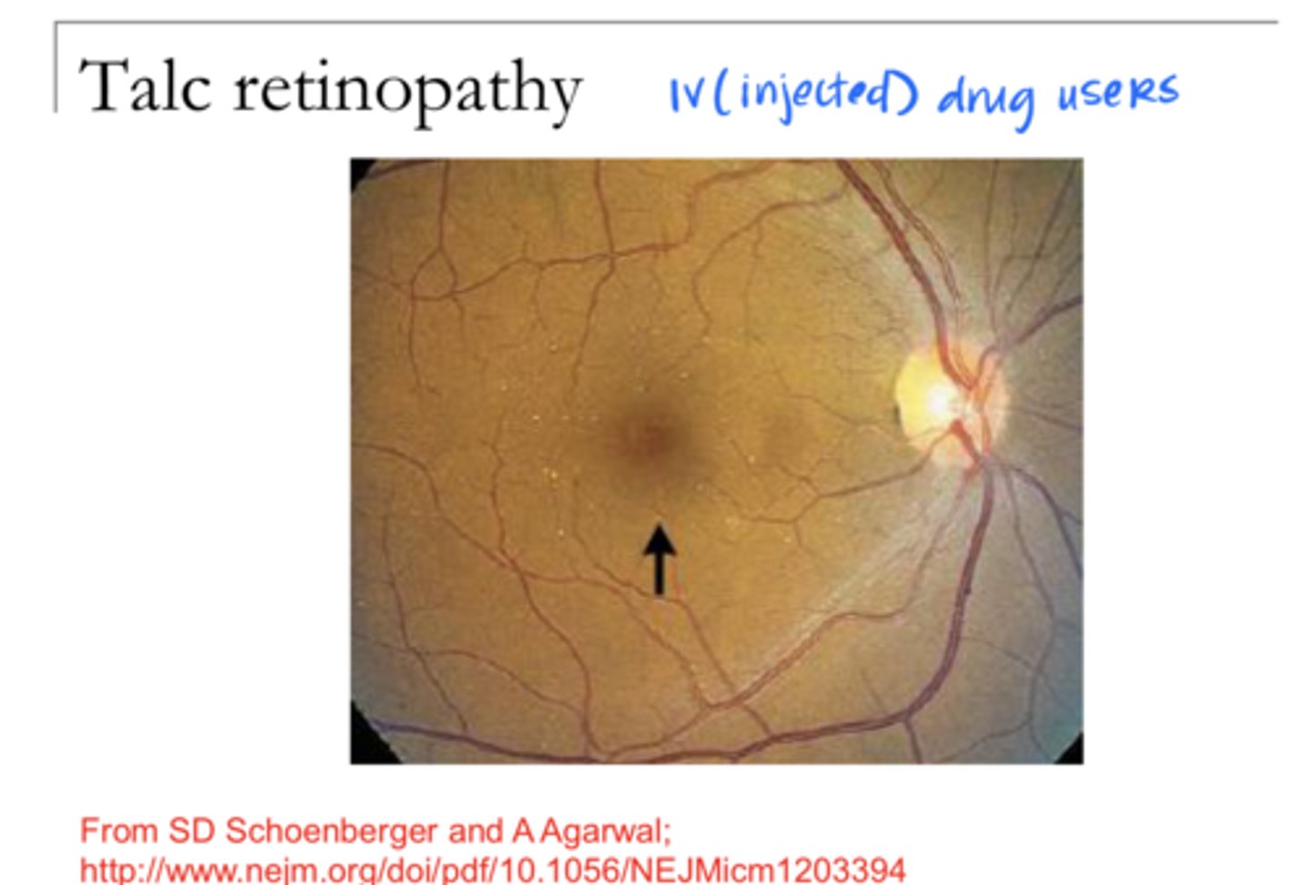 <p>Talc Retinopathy (Pic)</p>