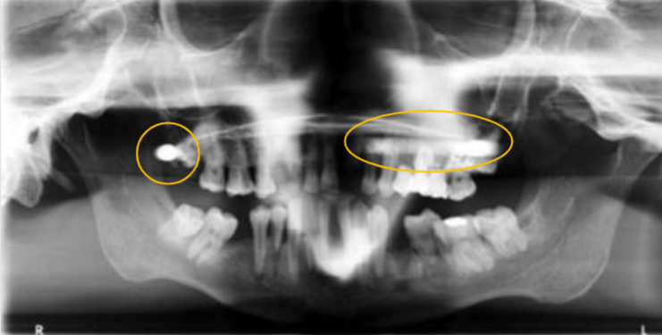 <p>what zone is this in of the focal trough? is it real or a ghost image or a double image </p>