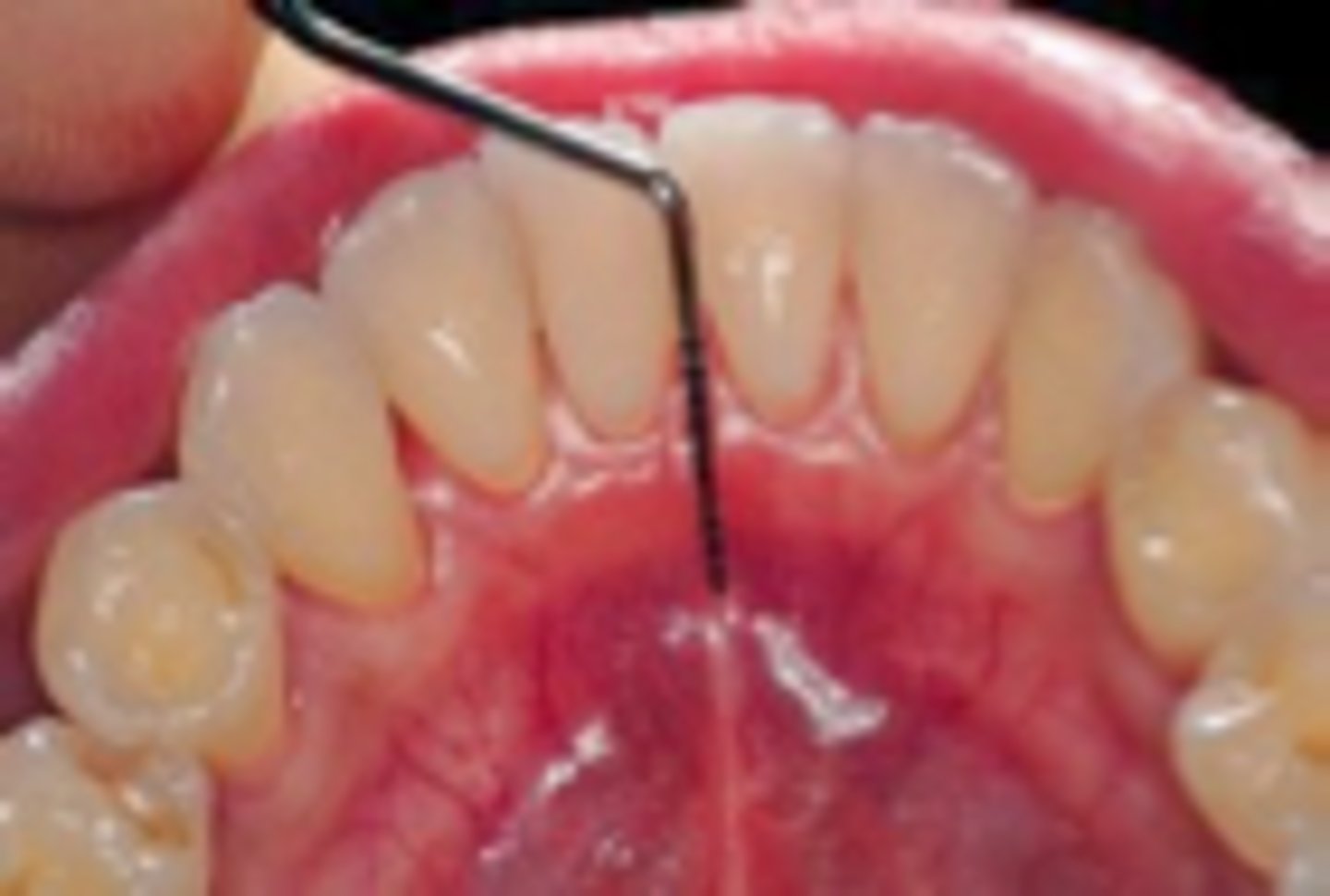 <p>A lingual bar Requires the functional depth of the vestibule be ______; bar height is 4 to 5 mm. This permits the major connector to have a minimum height of 5 mm and allows 3 mm of space between the gingival margins and the superior border of the bar.</p>