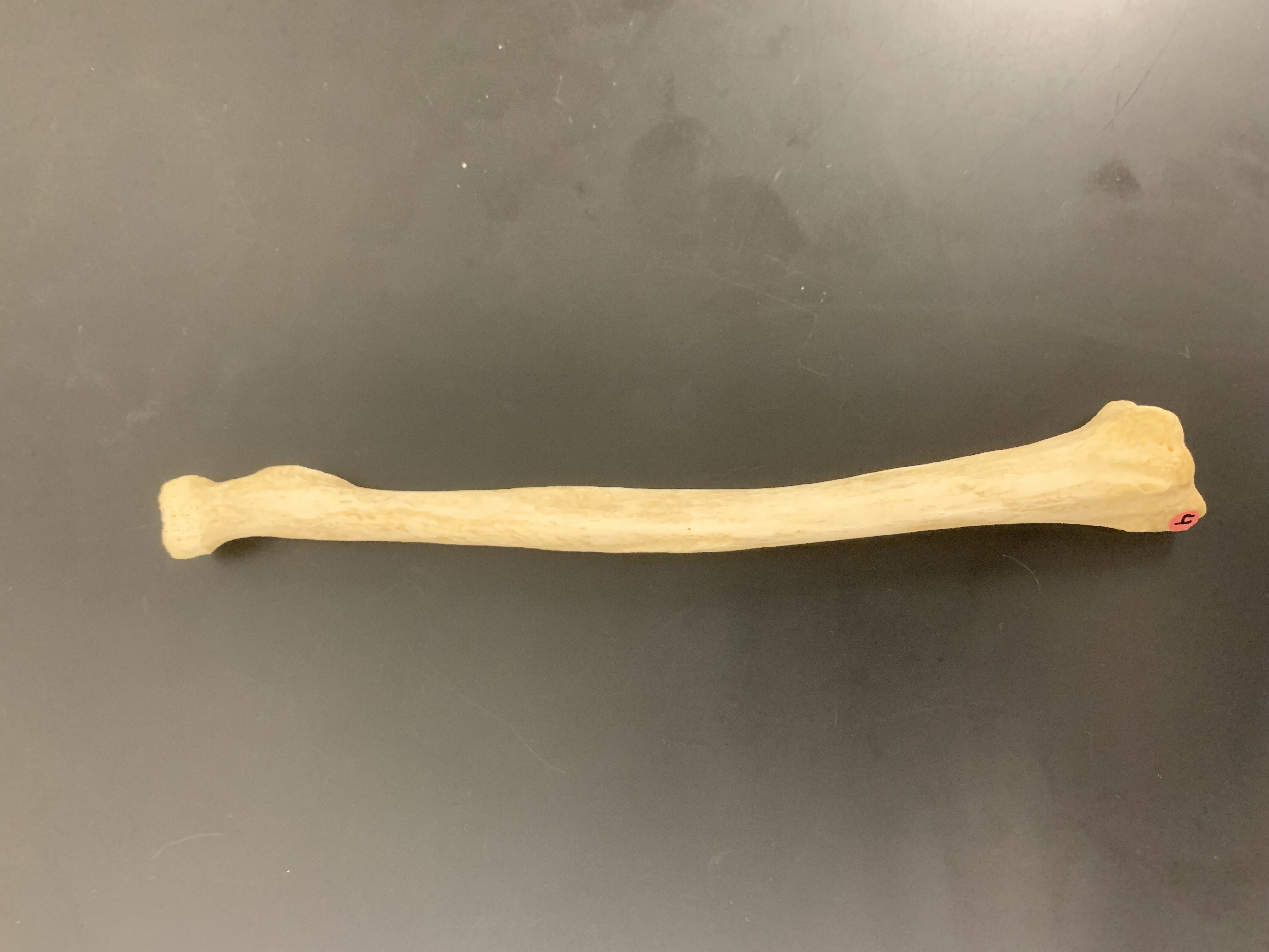 <p>Styloid process of radius</p>