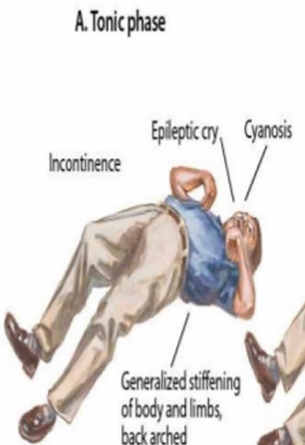 <p>only <span style="color: rgb(25, 161, 54);"><strong>STIFFENING </strong></span>part happens</p><p></p><p>s/s:</p><ol><li><p>increased <span style="color: rgb(221, 120, 120);"><strong>muscle tone</strong></span></p></li><li><p><span style="color: rgb(179, 115, 234);"><strong>loss of LOC</strong></span></p></li><li><p><span style="color: rgb(88, 92, 227);"><strong>stop breathing</strong></span></p></li><li><p><span style="color: rgb(187, 68, 19);"><strong>pee themselves</strong></span></p></li><li><p><span style="color: rgb(17, 144, 143);"><strong>salivate</strong></span></p></li></ol><p></p>
