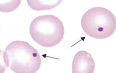 <p>RBC inclusion that is formed due to the Hgb being oxidized</p>
