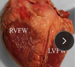 <p><span>Brisket edema; Mountain Sickness; High Mountain Dx</span></p>
