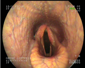 <p>AKP store husdyr blok 4 2024</p><p>Du ser følgende endoskopibillede på en hest med inspiratorisk bilyd. Du råder ejer til operation. Hvilken operation vil du anbefale?</p><p>1 Tie-back og ventrikulokordektomi </p><p>2 Tie-forward og ventrikulokordektomi </p><p>3 Tying up </p><p>4 Tying - left</p>