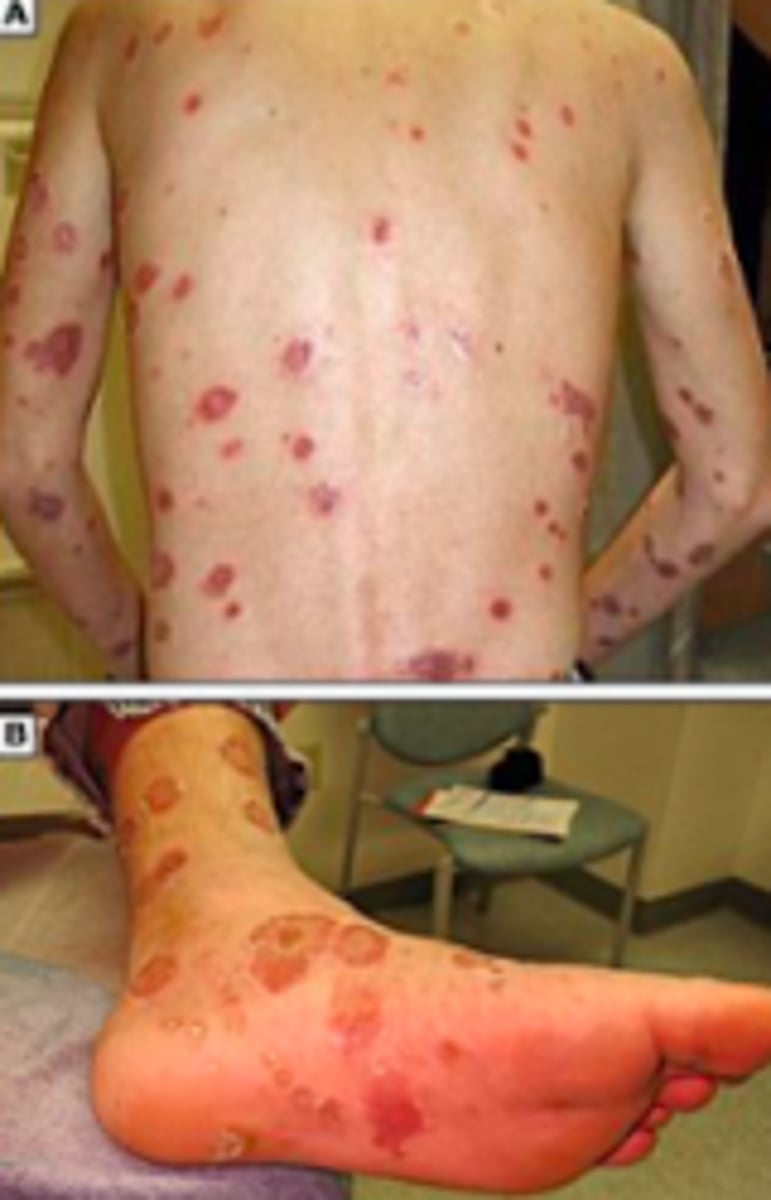 <p>Bacterial ID:</p><p>Objective:</p><p>- Adenopathy</p><p>- Epitrochlear nodes (antecubital space) is particularly suggestive (minimally ender, firm, rubbery consistency)</p><p>- Diffuse, symmetric macular or papular eruption</p><p>- Entire trunk and extremities including palms and soles</p><p>- Individual lesions: copper, red, reddish-brown; scaly and nodular</p><p>- Can involve mucosa</p>