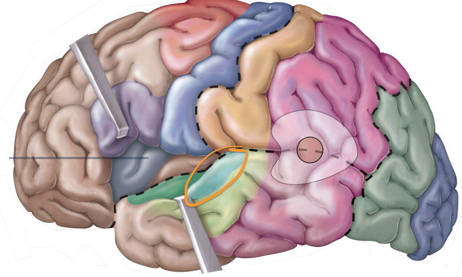 <p>Sensory Areas - <strong>1°auditory cortex</strong></p>