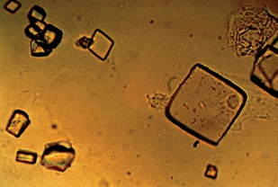 Uric acid crystals