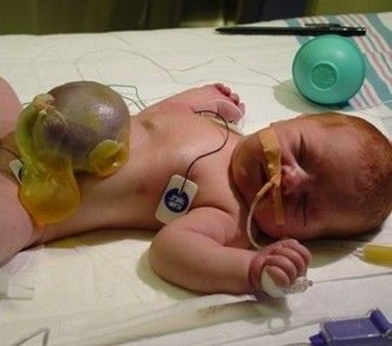 <p>Defect of the abdominal wall musculature resulting in protrusion of the abdominal viscera through the umbilical cord, encased by the peritoneum; in utero via US</p>