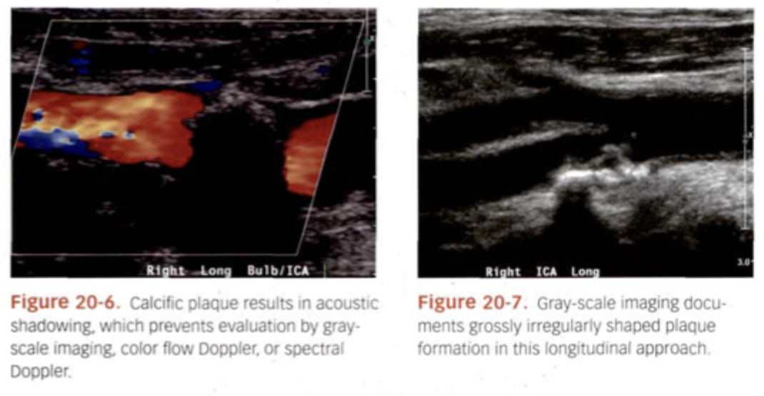 <p>All Hyperechoic with posterior shadowing.</p>