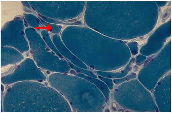 <ol><li><p>Identify the cellular adaptation</p></li><li><p>What stain is used in this slide?</p></li><li><p>What is the most common cause of this adaptation?</p></li></ol><p></p>