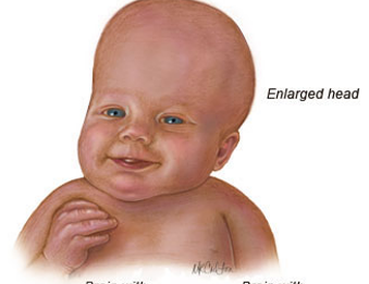 <p>What is the condition called when there is disturbed formation, flow, or absorption of CSF leading to increase volume in CNS during childhood?</p>