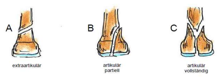 <p>A: extraartikulär</p><p>B: artikulär partiell</p><p>C: artikulär vollständig</p>