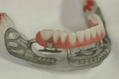 <p>What are subperiosteal implants (eposteal)?</p>