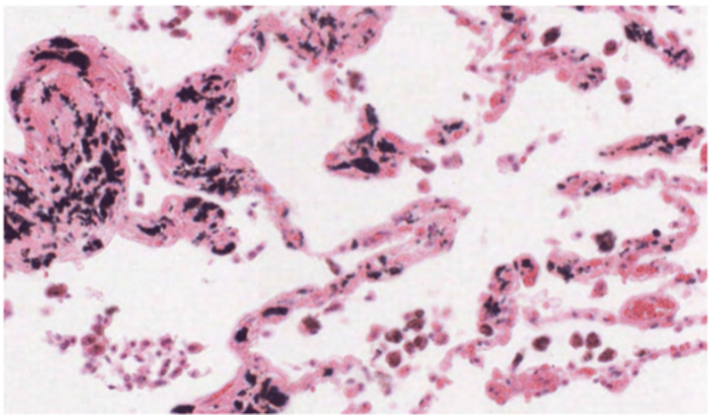 <p>anthracotic pigment (anthracotic = black). Smokers will present many more . Particles present in the air</p><p>Pulmonary macrophages will be responsible for removing these particles, which is why they are generally seen containing black stuff inside of them.</p>