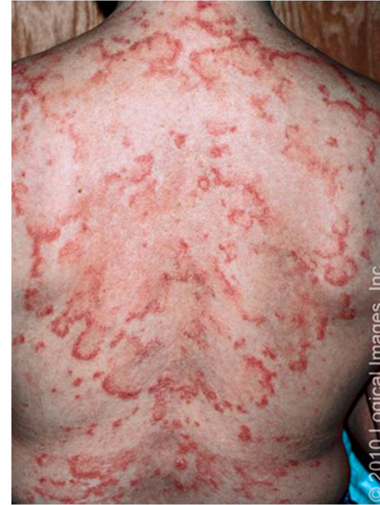 <ul><li><p>small, erythematous, slightly scaly papules that evolve into either psoriasiform or annular plaques</p></li><li><p><u>location</u>: shoulders, forearms, neck, upper torso</p></li><li><p><u>risk</u>: sun exposure, drug induced (anticonvulsants, ACEI, BBs, immune modulators)</p></li><li><p><u>histology</u>: superficial perivascular and appendageal lymphocytic infiltration; vascuolization of basement membrane and mucin deposition in dermis</p></li></ul><p></p>
