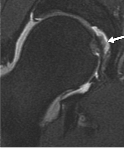 <p>Ligamentum Teres Tear: S/S</p><ul><li><p>What activities would this pt complain of having difficulty doing?</p><ul><li><p>3</p></li></ul></li></ul><p></p><p></p>