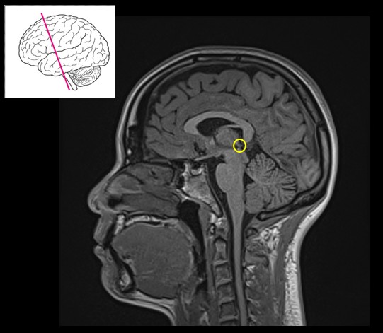 <p>Pineal gland.</p>