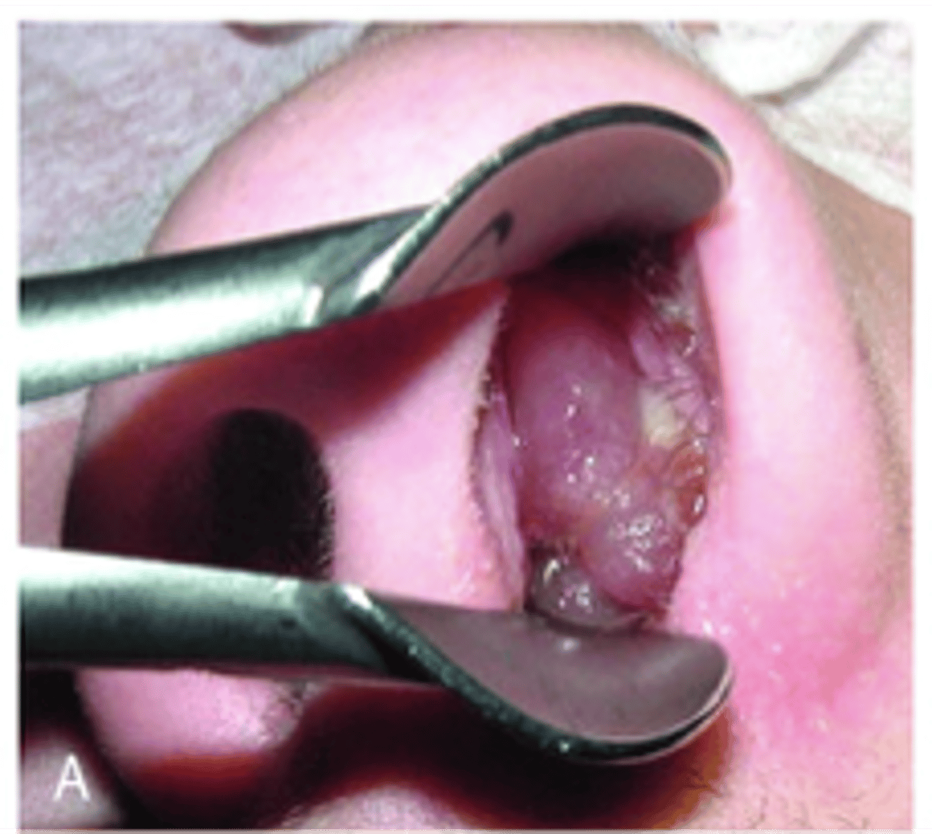 <p>Nasal polyp treatment?</p>