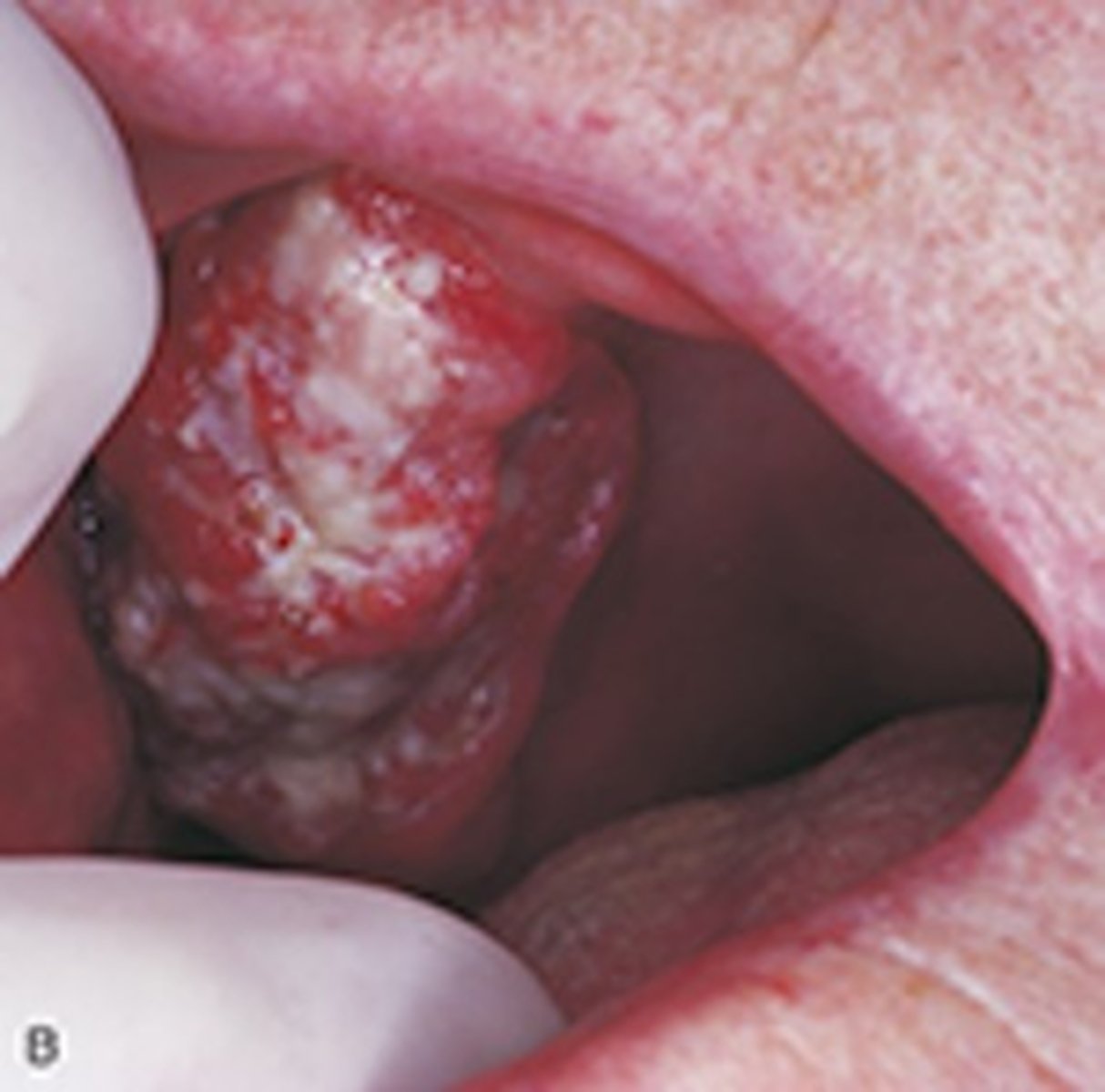 <p>Specific type of squamous cell carcinoma that is separated from other squamous cell carcinomas because it has a much better prognosis</p>